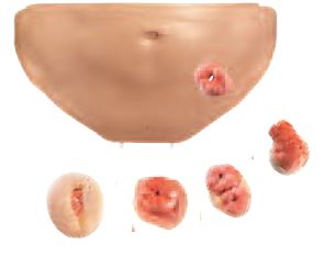 CLA 411 Abdominal cavity cover with colostomy